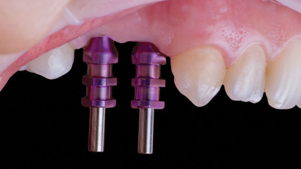 Open-tray impression copings are attached to the implants