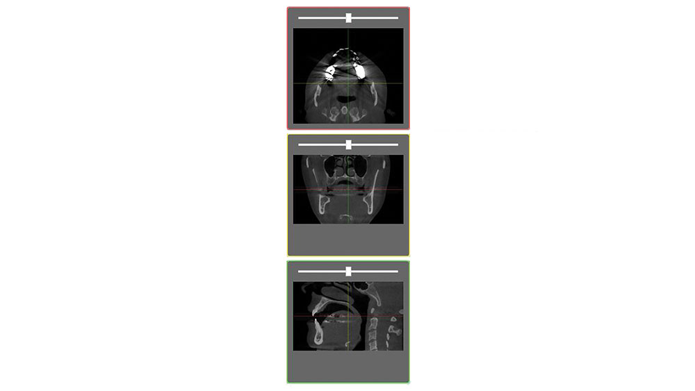 CBCT scan performed on patient