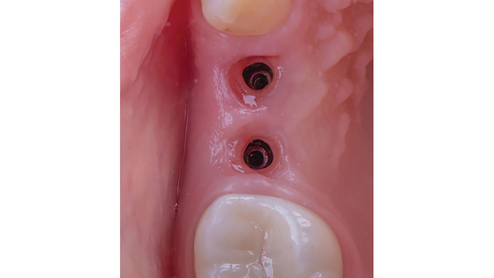 Close-up of the DTP procedure after four months of healing
