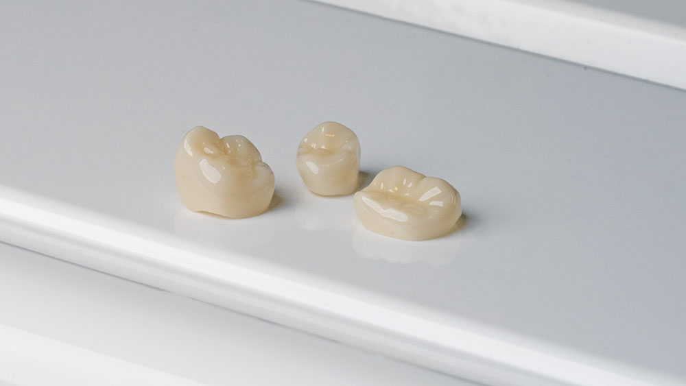 Milled crowns using CAD/CAM