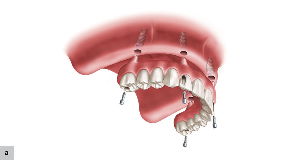 full-arch implant prosthesis without transmucosal