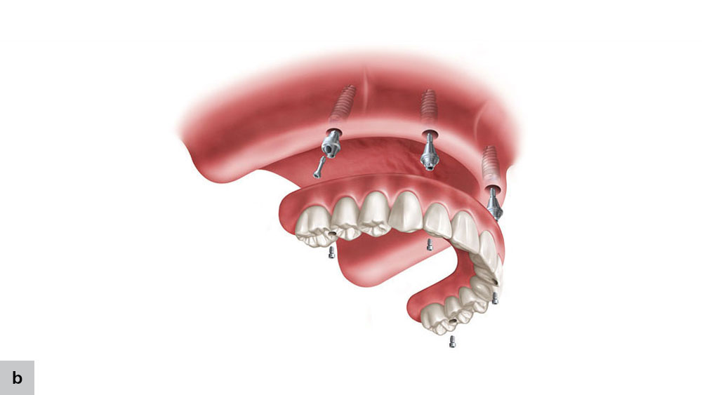 full-arch implant prosthesis with transmucosal