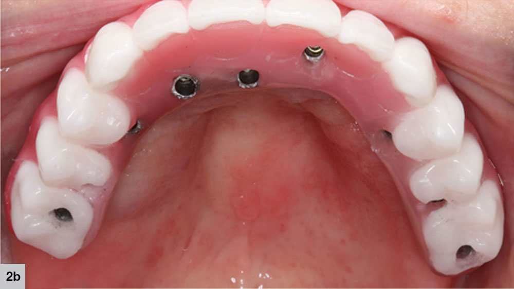wax try-in for the bruxzir full-arch implant prosthesis