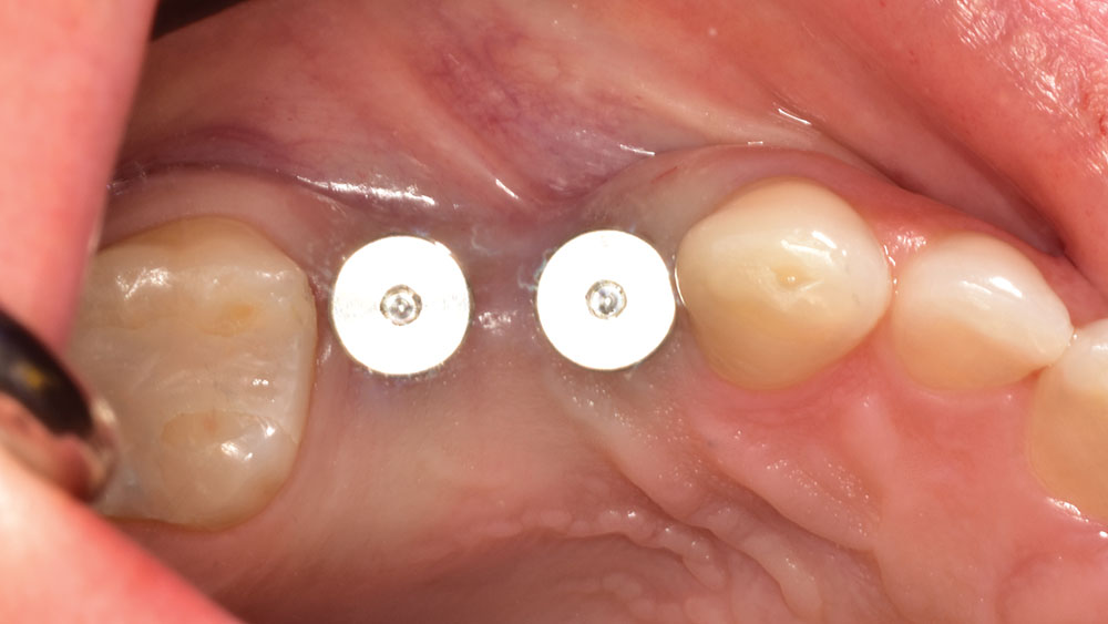 Hahn Tapered Implants placed via guided surgery