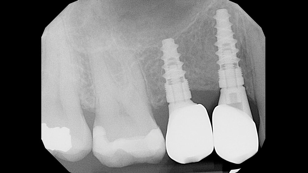 Radiograph showing integration of the implant