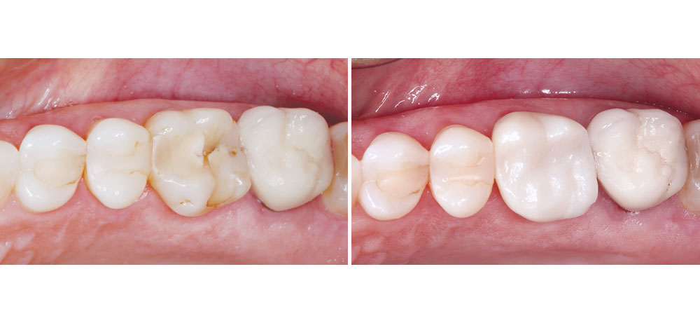 Before and after photo of patient's teeth with BruxZir Now crowns