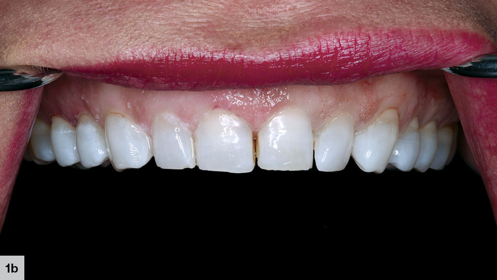 Class III restorations on teeth #7 and #10