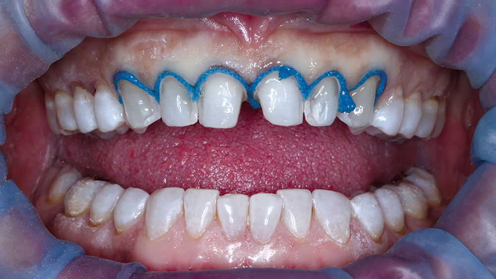 a size-one light blue cord placed all around the gingival margins