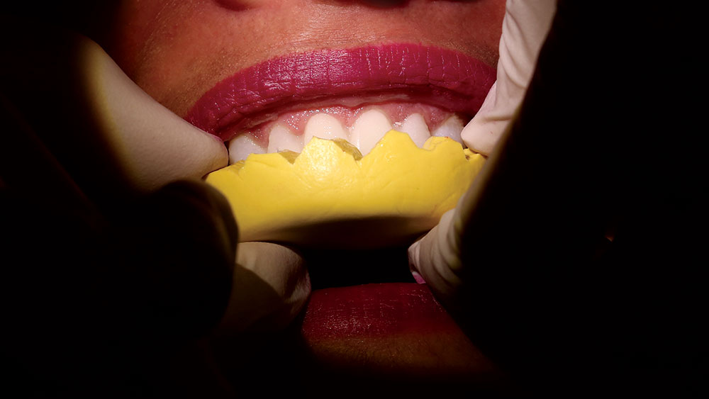 putty matrix being seated over patient's teeth