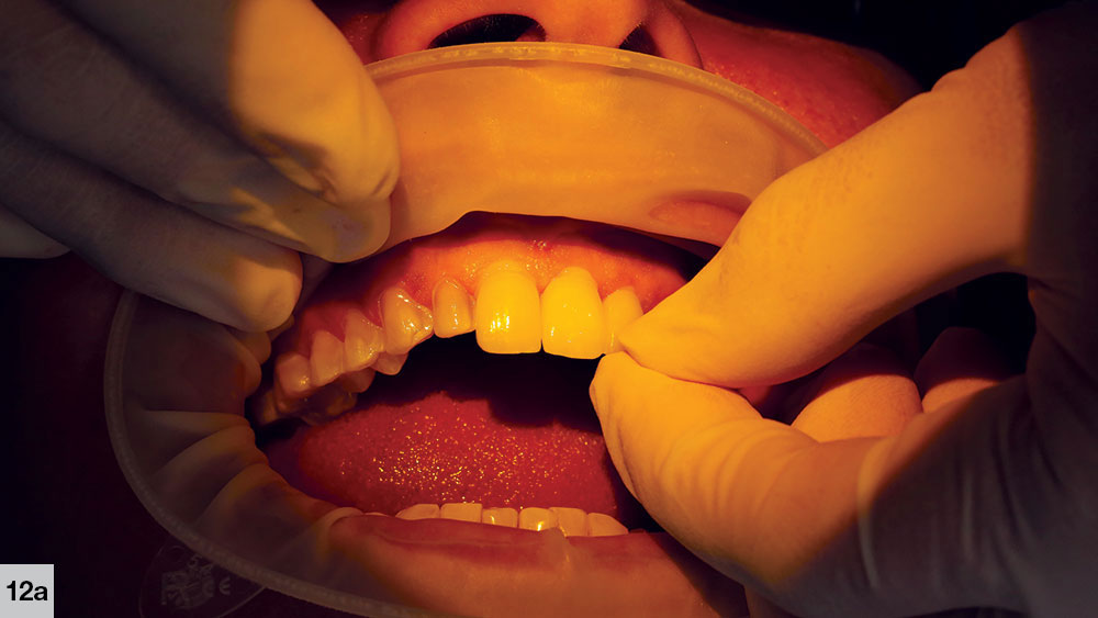 doctor checking patient's restorations