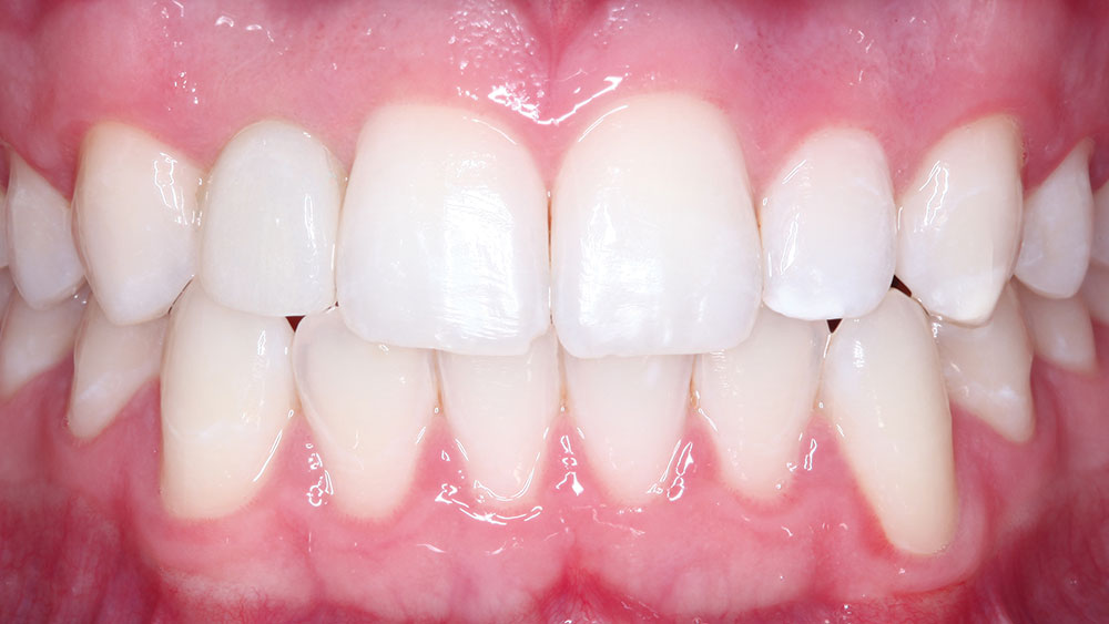 Screw-retained is added displaying perfect, natural esthetic of patient's teeth
