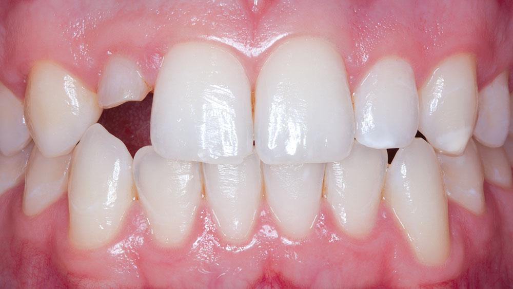 Close-up of patient with lateral incisor