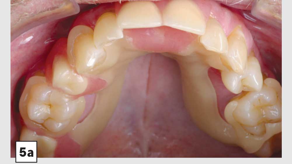 Milled Acetal Partial Dentures A Clinical Case Report Exploring a New