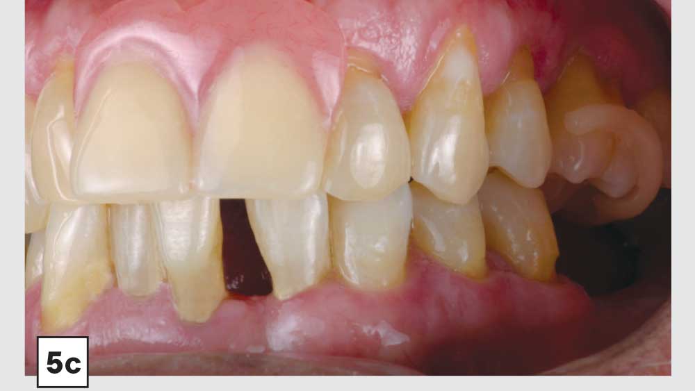 Milled Acetal Partial Dentures A Clinical Case Report Exploring a New