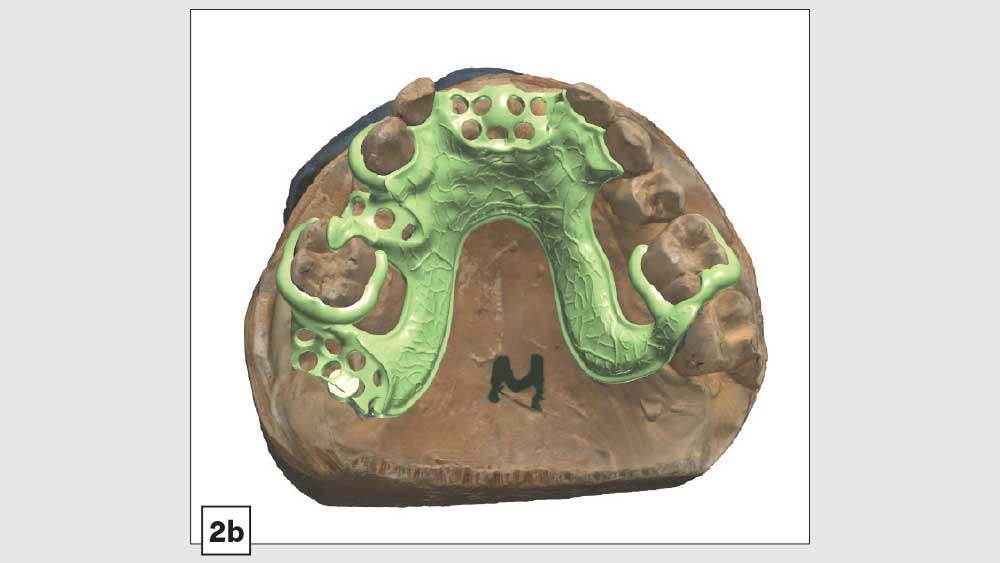Milled Acetal Partial Dentures A Clinical Case Report Exploring a New
