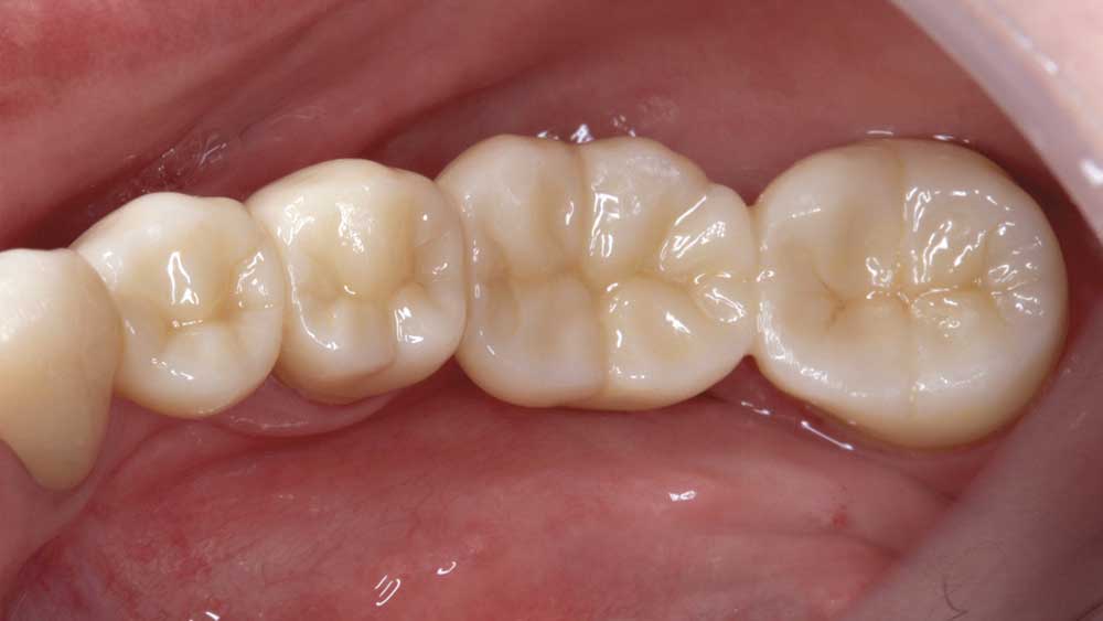 Close-up of patient's teeth