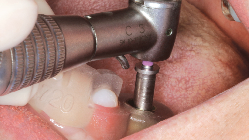 drilling with the Hahn Tapered Implant Guided Surgery System