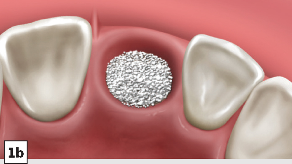 Extraction and Socket Grafting Part 3 — Socket Grafting Protocol