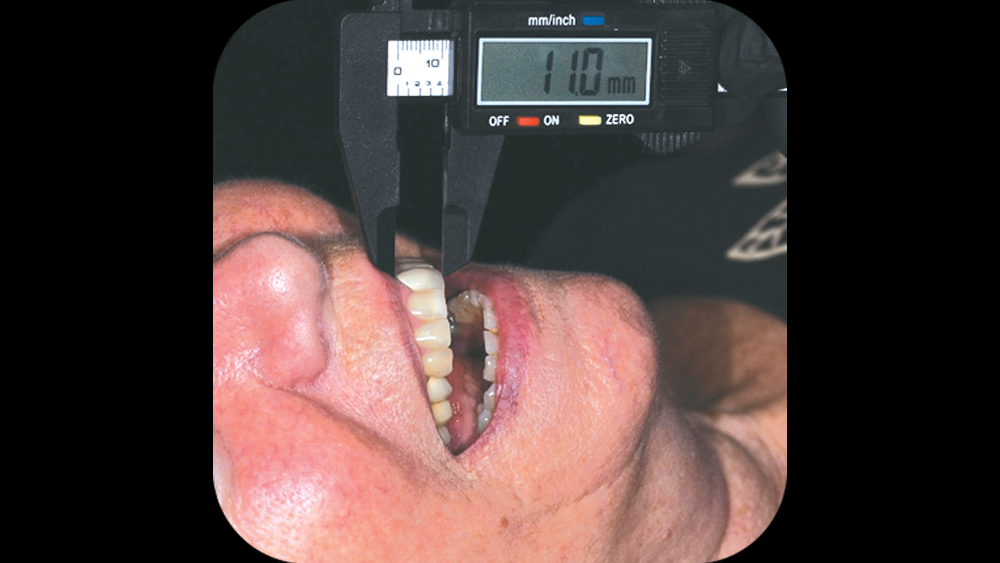 measure the central incisor