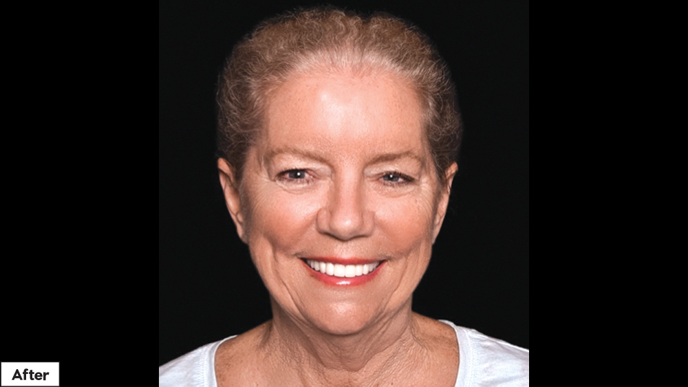 Using BioTemps Provisionals for Dental Case Acceptance