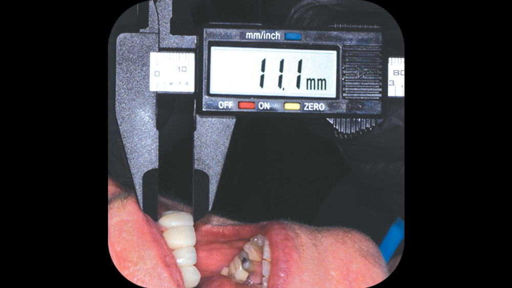 Using BioTemps Provisionals for Dental Case Acceptance