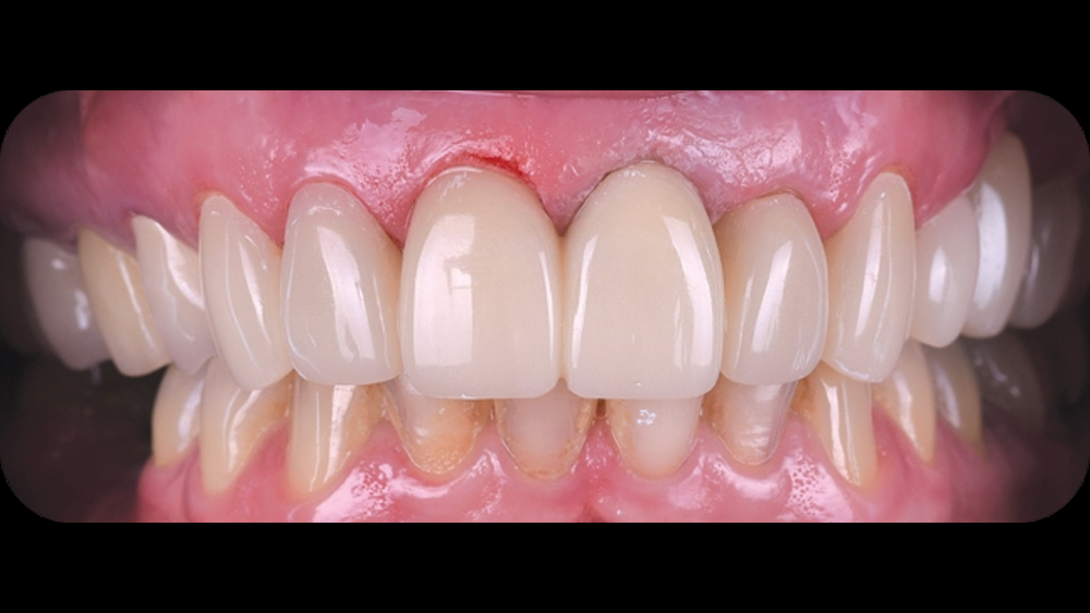 Using BioTemps Provisionals for Dental Case Acceptance
