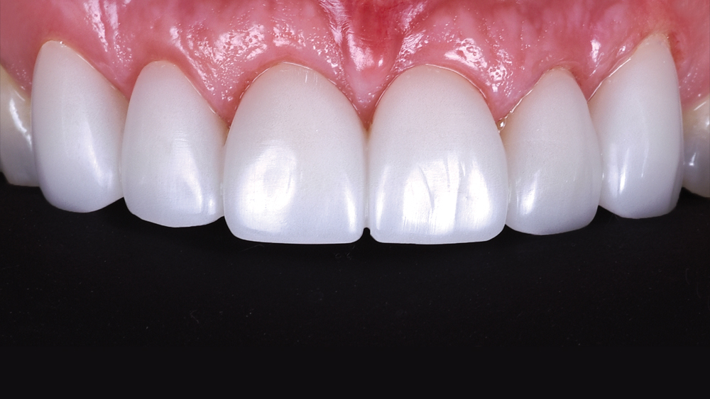 Using BioTemps Provisionals for Dental Case Acceptance