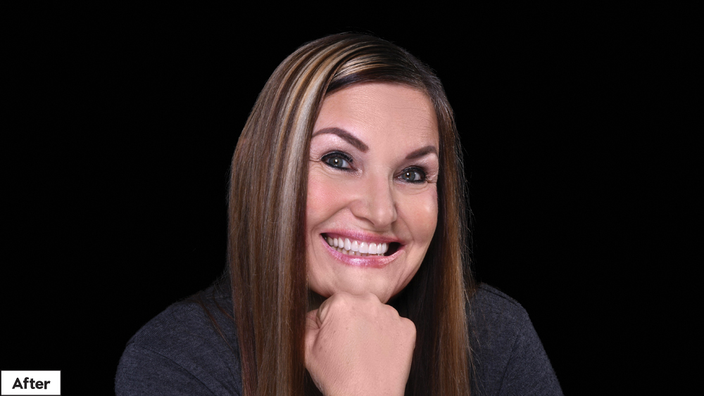 Using BioTemps Provisionals for Dental Case Acceptance