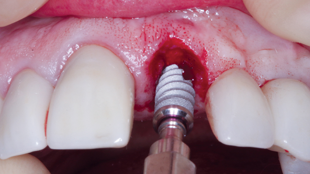 Surgical placement of implant
