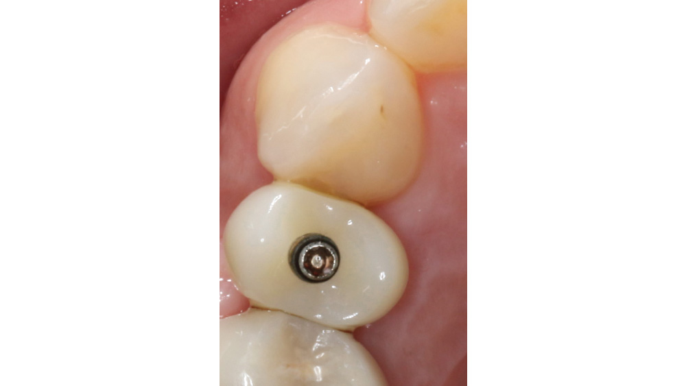 Screw-retained crowns were sealed with composite on implant site