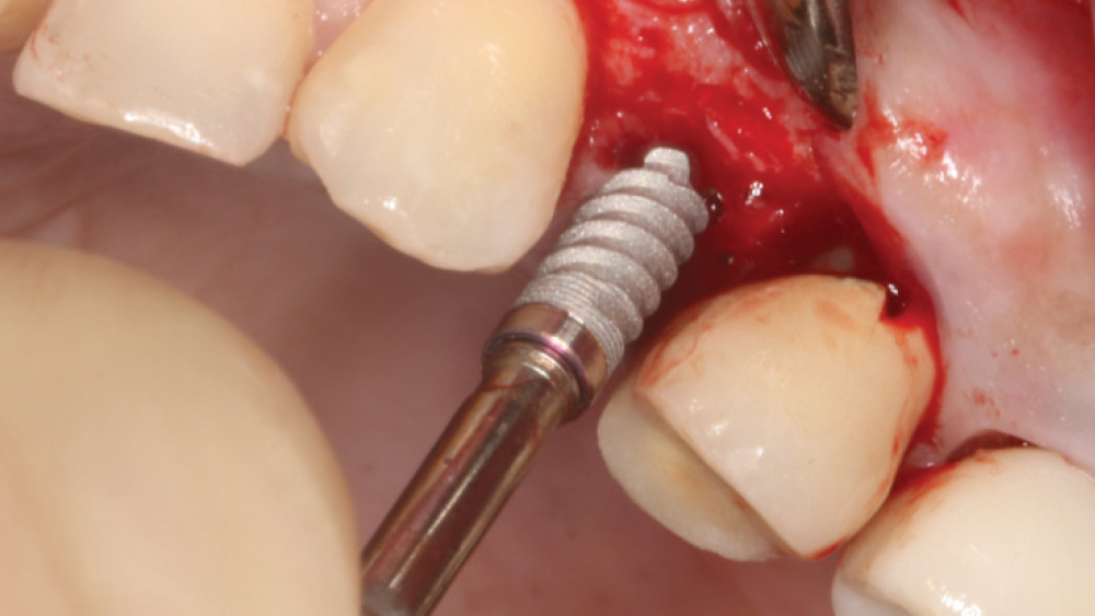 Another angle of 3.5 mm Hahn implants were threaded into position