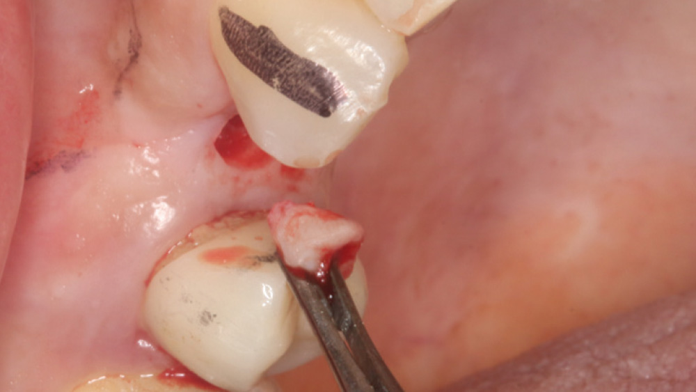 A tissue punch was used to provide access to the maxillary right bicuspid site, facilitating the flapless procedure