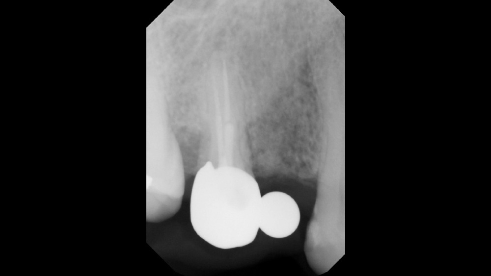 Flapless Dental Implant. When to Use a Flapless Technique?