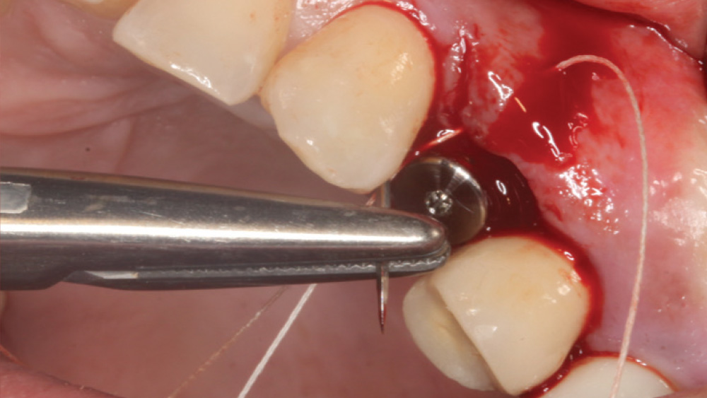 Close-up of suturing process