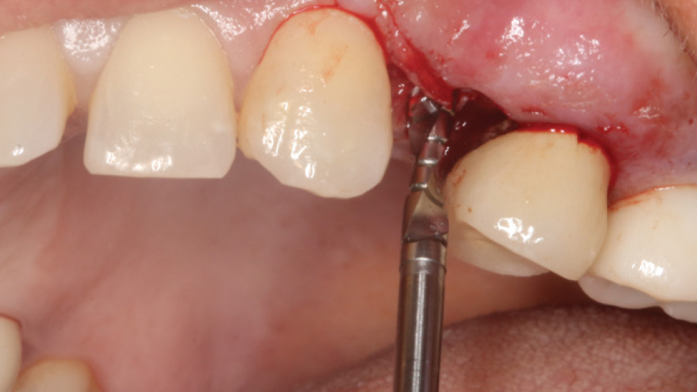 2.4-mm-diameter pilot drill is used on the site for depth and angulation of the implant osteotomy