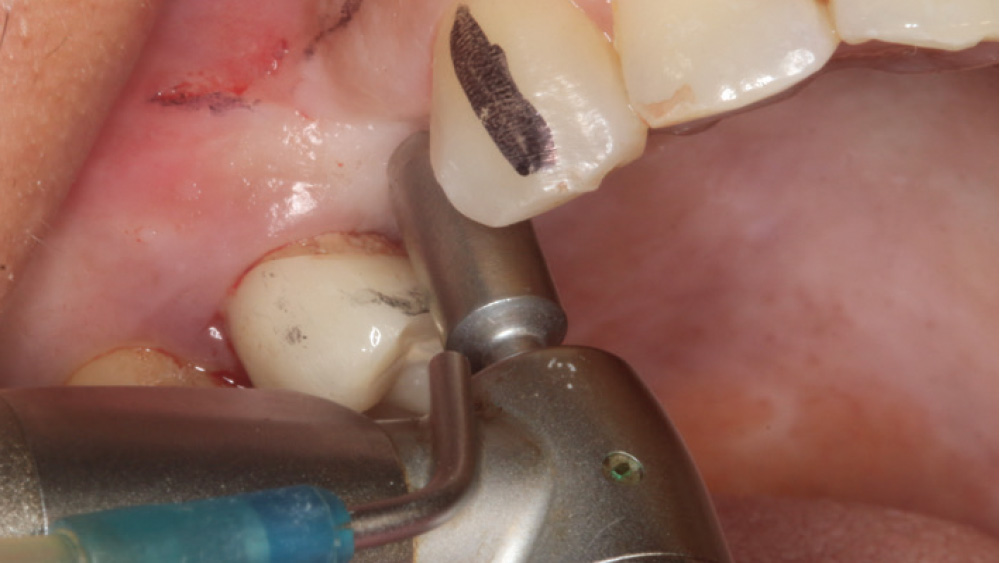 A tissue punch was used to provide access to the maxillary right bicuspid site, facilitating the flapless procedure