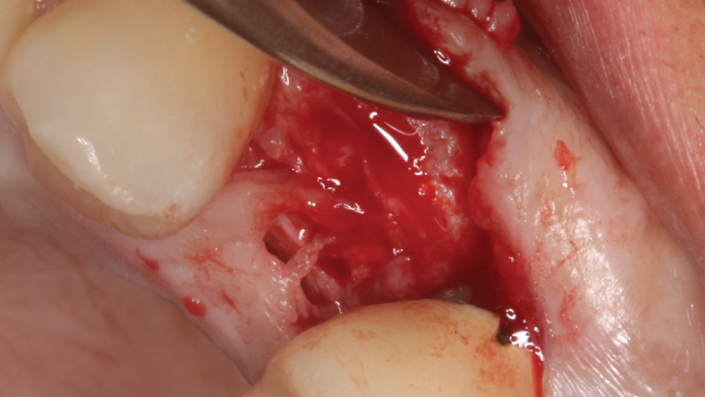 Tooth #12 incision made on the edentulous crest around the adjacent teeth