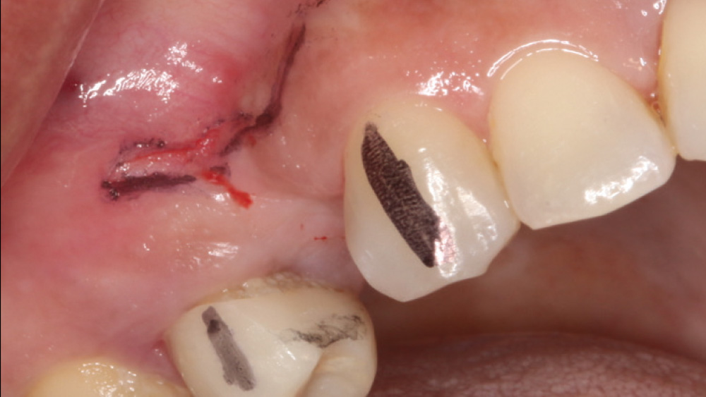 Attached gingiva is verified and mucogingival line is assessed with marker