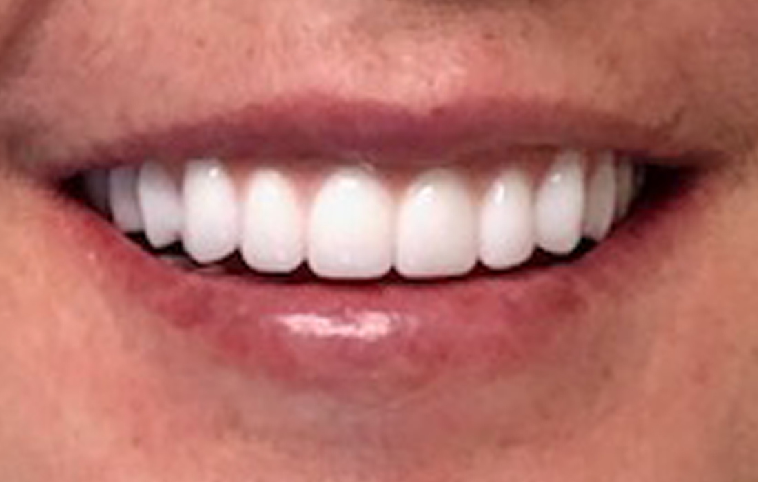 Patient's smile after BruxZir Implant Prosthesis