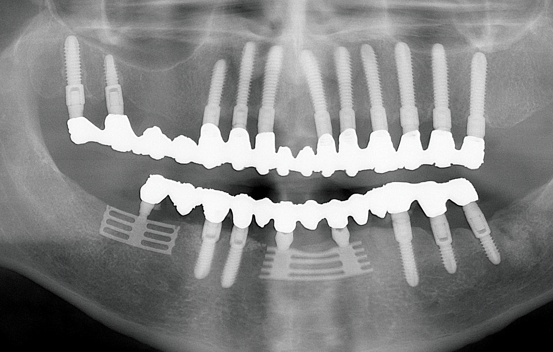 Steri-Oss Implant CSM Image 1 V15I2