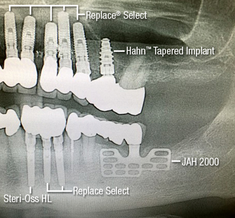 Replace Select and Hahn Tapered Implant x-ray