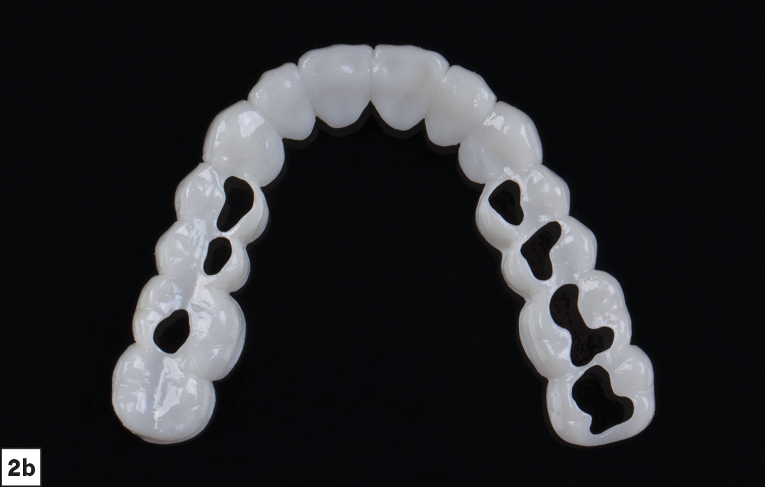 The lab can fabricate a Smile Transitions appliance that includes occlusal cutouts, upon request