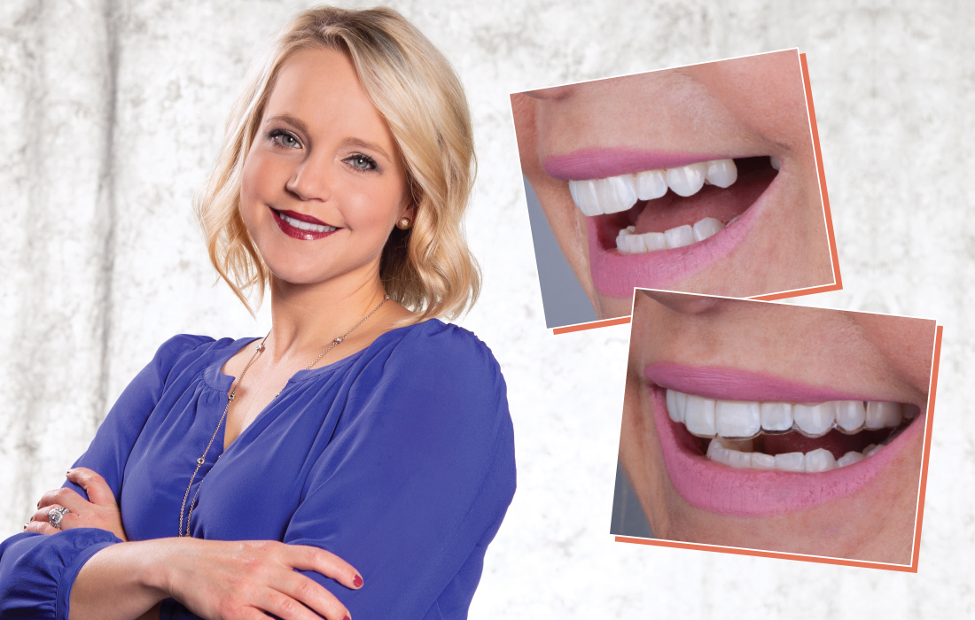 4 Ways to Temporize Dental Implants
