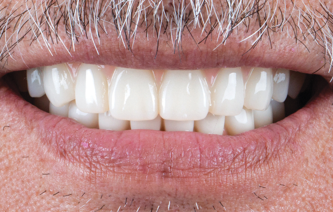Close-up of patient with BruxZir Implant Prosthesis