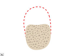 Guided Bone Regeneration: 8 Augmentation Steps | Glidewell