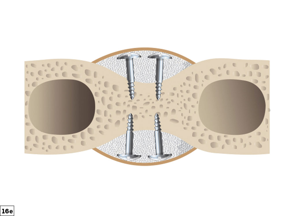 Guided Bone Regeneration 8 Augmentation Steps Glidewell