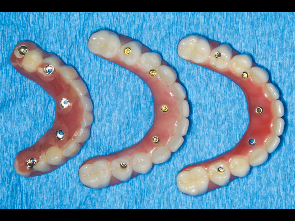 The denture converted to a fixed appliance