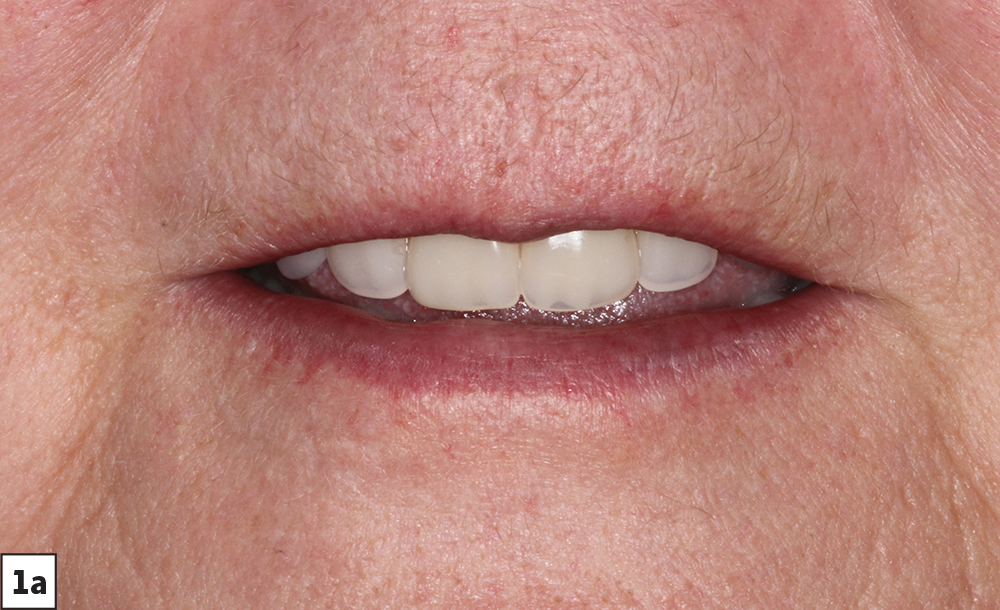 Figure 1a - patient smile before overdentures - V15I2