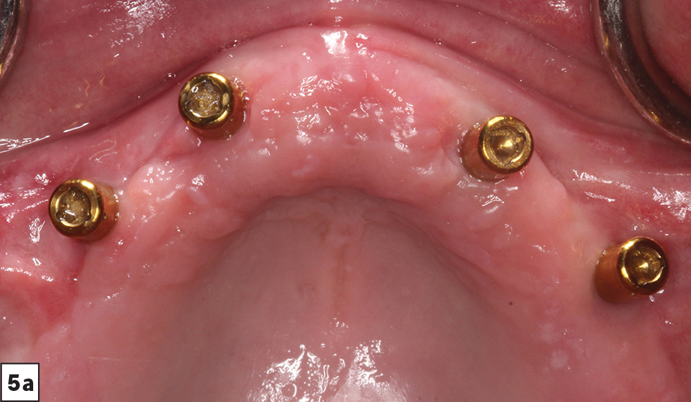 Figure 5a - Locator abutments in patient mouth - V15I2