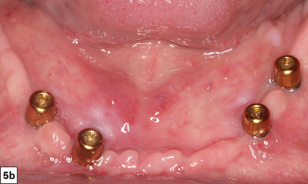 Figure 5b - Patient with Locator abutments - V15I2